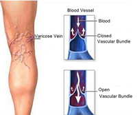 support stocking for varicose veins