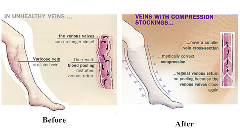 Varicose Vein