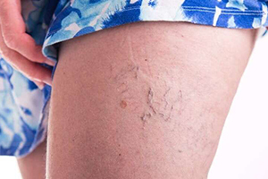 woman's leg varicose veins
