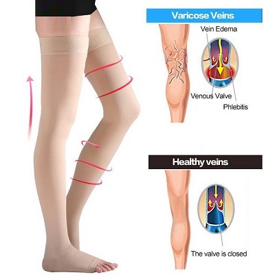 varicose veins and healthy veins, person wearing thigh high open toe compression socks