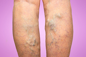 varicose veins