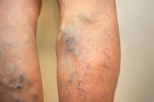 legs with varicose veins