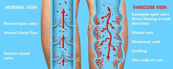 Normal veins vs unhealthy veins