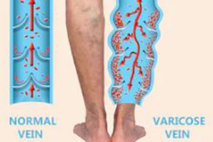varicose veins can be treated with medical hoses