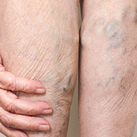 varicose veins can be treated with 15 - 20 mmHg, 20 - 30 mmHg, or 30 - 40 mmHg knee high or thigh high hosiery