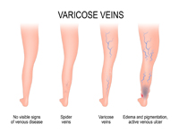 picture of normal veins and varicose viens due to edema causing swelling