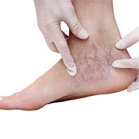 varicose veins in feet and ankles