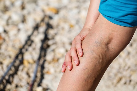 Varicose veins are not only unsightly. They can also cause other side effects such as itchiness and pain.