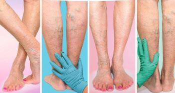 legs with varicose veins