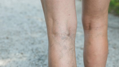 varicose veins on legs