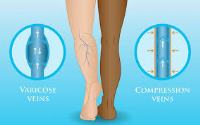 Image showing varicose vein