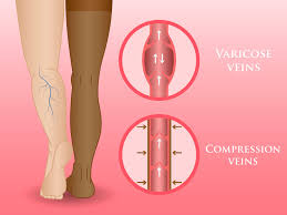 image showing effects of DVT