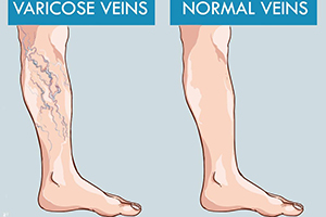 varicose veins vs normal veins