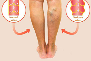 varicose veins vs. normal veins
