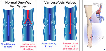 visual representation of normal versus damaged valves and how they cause varicose veins