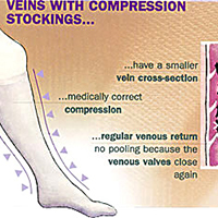 healthy veins after wearing 15 - 20 mmHg, 20 - 30 mmHg, or 30 - 40 mmHg knee high or thigh high hosiery