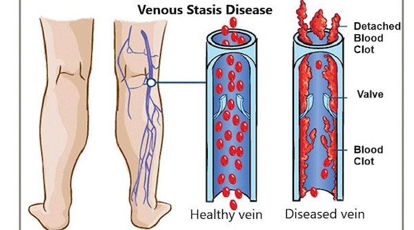 Graphic of venous reflux diseases showing how blood flow works between healthy vein valves and damaged vein valves