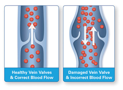 Graphic of healthy and damaged vein valves explaining blood flow 