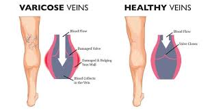 image showcasing difference between healthy and varicose veins as a result of compression socks