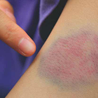 visible clots