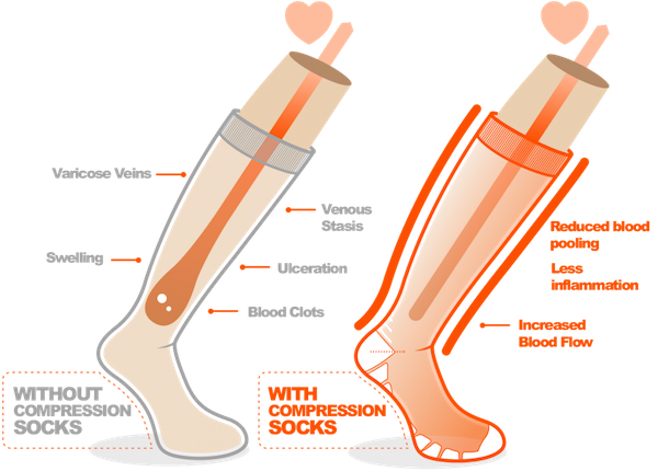 Graphic comparing Without vs With circulation sock