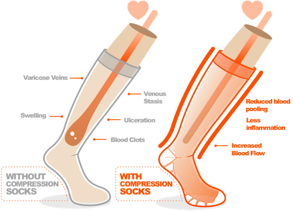 Diagram of Without compression socks vs With compression socks