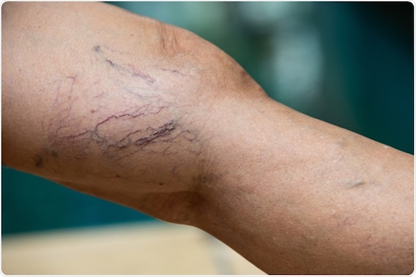 Picture of varicose veins