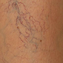 how spider veins look like