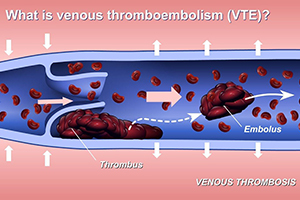 what is VTE