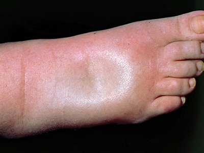 Leg edema