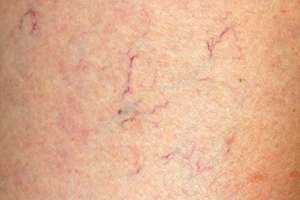 what is spider veins