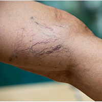 what is varicose veins