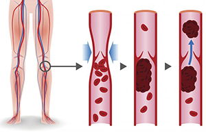 women legs support hosiery can prevent blood clots