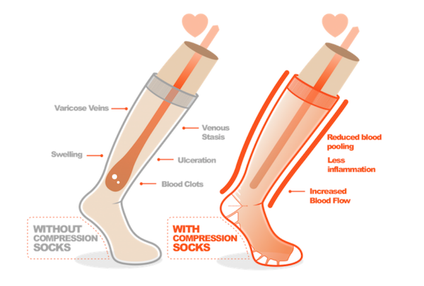 visual representation of what compression socks does to your body