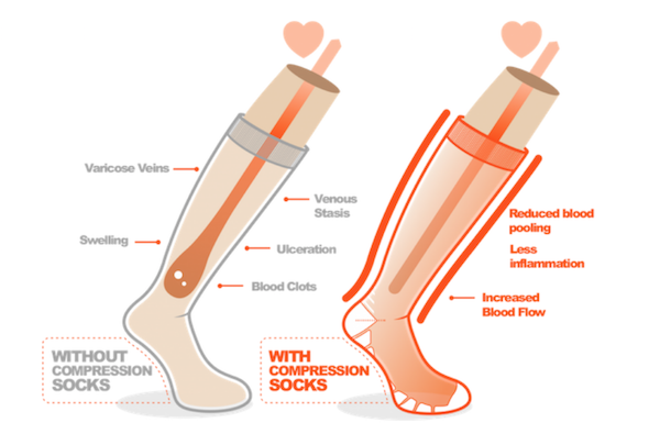 Wearing circulation legwear to improve blood flow and better health vs without